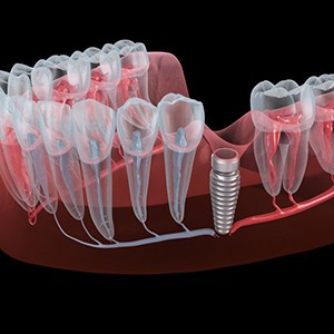 Illustration of implant placed in gum tissue
