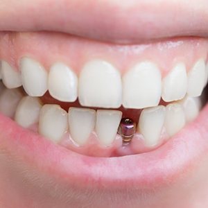 Smile with dental implant
